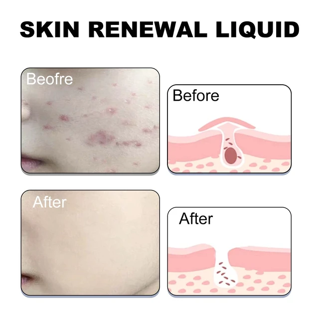 Alt view image 4 of 6 - Moisture Replenishment & Skin Barrier Restoration, Gentle Purifying Essence for Acne Repair, West Month Salicylic Acid Acne Serum