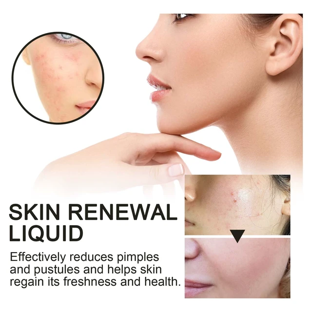 Alt view image 3 of 6 - Moisture Replenishment & Skin Barrier Restoration, Gentle Purifying Essence for Acne Repair, West Month Salicylic Acid Acne Serum