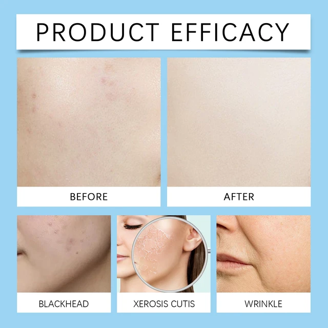 Alt view image 2 of 5 - Salicylic Acid Face Serum Hydrating Moisturizing Anti-Acne Closed Comedones Skin Renewal Essence
