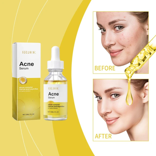 Alt view image 2 of 6 - Effective on Closed Comedones, Gentle Facial Essence for Acne Cleansing & Repair