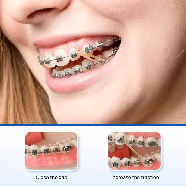 Alt view image 3 of 7 - JMU Orthodontic Elastics 5/16 Medium, 500 Pack Dental Rubber Bands Latex