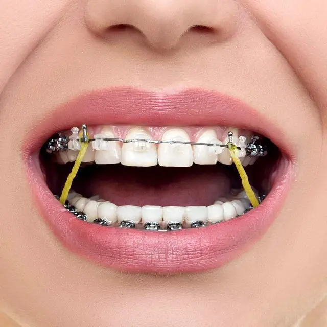 Alt view image 3 of 7 - JMU Orthodontic Rubber Bands 5/16 Heavy, 100 pack Intraoral Braces Elastics