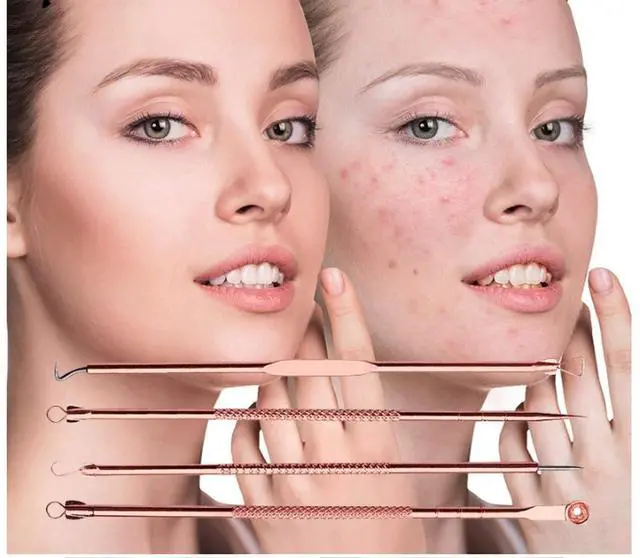 Alt view image 4 of 6 - Blackhead Remover Pimple Comedone Extractor Tool Acne Removal Kit 4 Piece Set with Case for Nose Face Skin - Rose