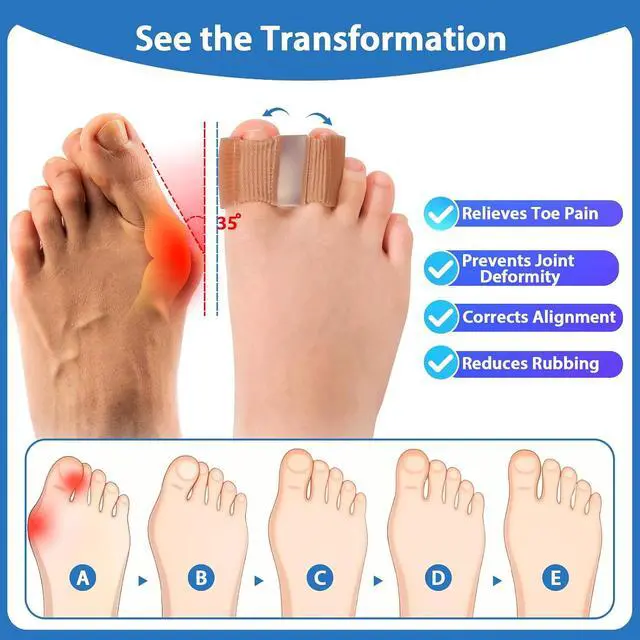 Alt view image 5 of 7 - Bunion Toe Separators for Overlapping Toes, 3-Point Support Gel Toe Spacers with 2 Fabric Lining Loops for Toe Protectors, Bunion Corrector for Women Men Big Toe(L)