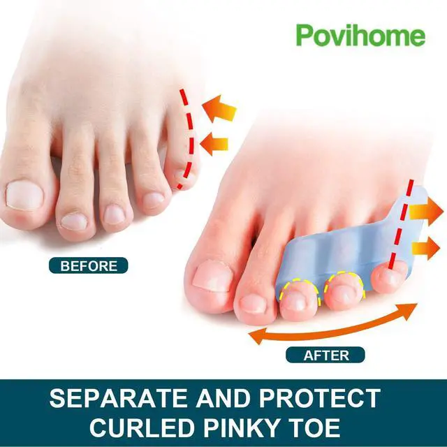 Alt view image 3 of 7 - Povihome 10 Pack Pinky Toe Separator and Protectors for Overlapping Toe, Curled Pinky Toes - Spacers for Morton's Neuroma Pain Relief