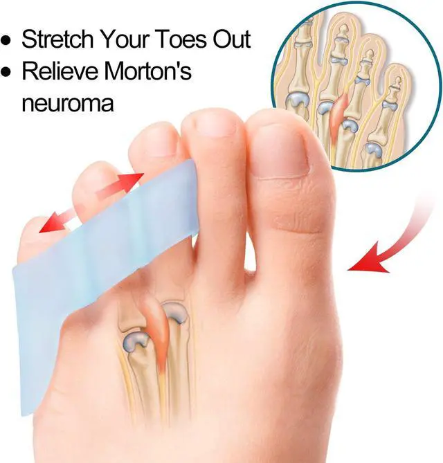 Alt view image 4 of 7 - Povihome 10 Pack Pinky Toe Separator and Protectors for Overlapping Toe, Curled Pinky Toes - Spacers for Morton's Neuroma Pain Relief