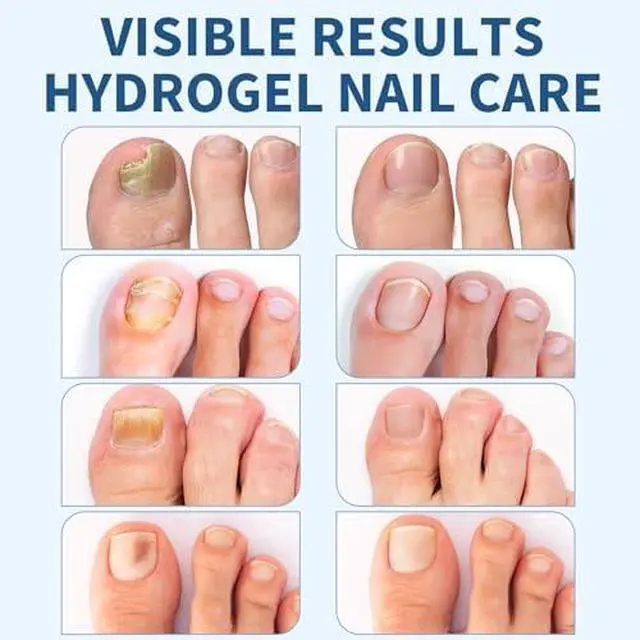 Alt view image 6 of 7 - TEAWOO 50PCS Toenail Nail Patches, Self-Adhesive Conditioning Stickers | 8-Hour Overnight, for Thick Discolored Brittle Damaged Nails, Daily Nail Care for Men & Women