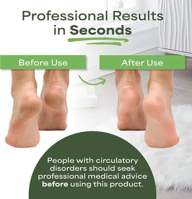 Alt view image 5 of 6 - Pumice Stone for feet Extra Large Foot File & Callus Remover for Cracked Heels Double Sided Pedicure Tool for Dead Skin Podiatrist Recommended