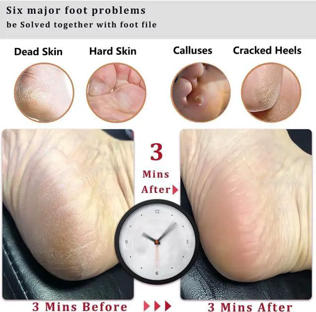 Alt view image 4 of 6 - Kinepi Callus Remover Foot File, Pumice Stone for Feet Scrubber Wet and Dry | Wooden pedicure foot rasp helps smooth dead skin, cracked heels, and hard skin for daily or weekly care after shower