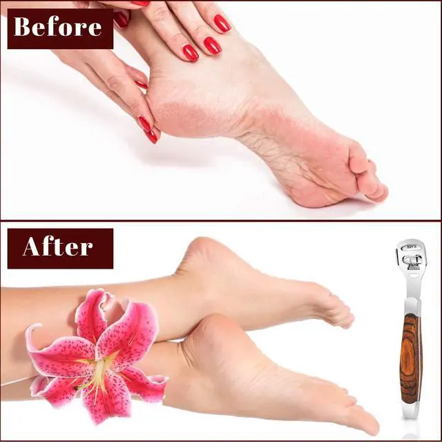 Alt view image 7 of 7 - 15 Pcs Callus Shaver, Foot Shaver Callus Remover for Feet Hand Care | Stainless Steel Shaver and Wooden Handle, With Foot File, 10 Pcs Blades, Foot File Head and Dead Skin Storage Cover