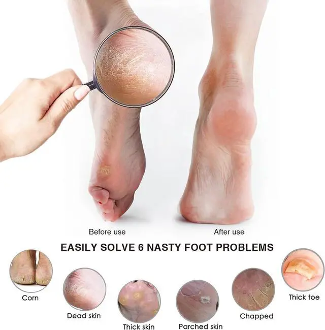 Alt view image 5 of 7 - Pumice Stone Foot File, Wooden Handle Foot Scrubber & Callus Remover | for women and men with dry rough cracked heels, home pedicure, shower spa routine, corns and hard skin care use(2-Pack)