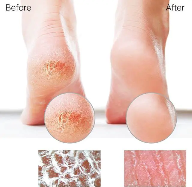 Alt view image 3 of 7 - Glass Foot File Callus Remover for Feet, Heel Scraper, Pumice Stone, Diabetic Feet Scrubber Dead Skin Remover for Feet Professional Pedicure Tools