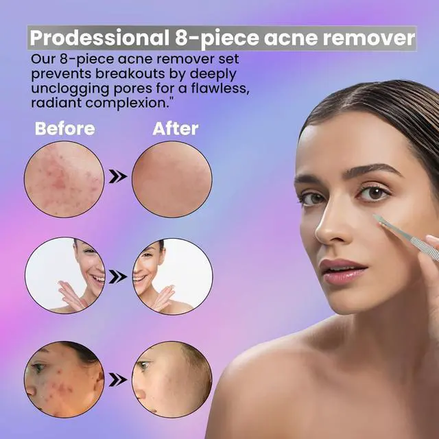 Alt view image 4 of 7 - Acne Needle Blackhead Remover Comedone Extractor Pimple Blemish Tweezer Tool Kit