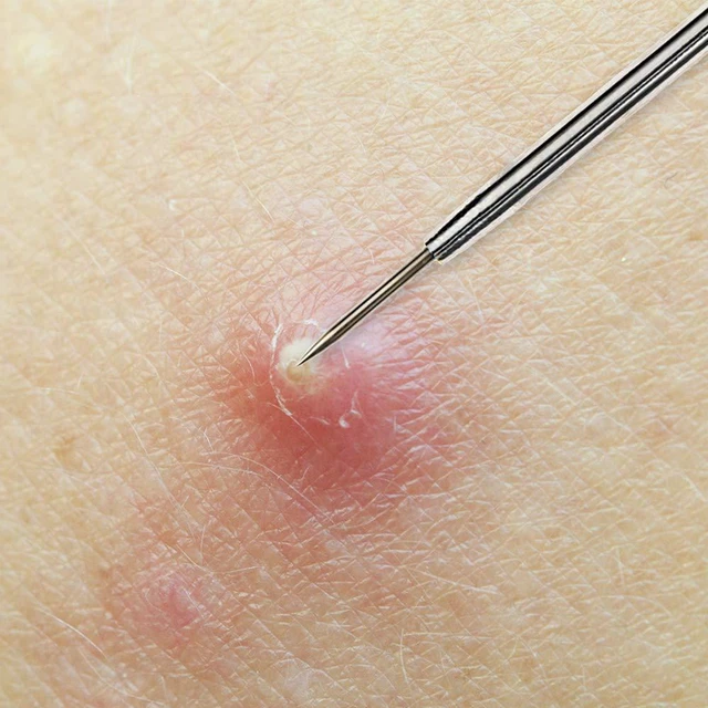 Alt view image 3 of 5 - Beaute Galleria Blackhead Remover Needle Pimple Extractor Popper Acne Comedone Blemish Whitehead Zit Removal Tool