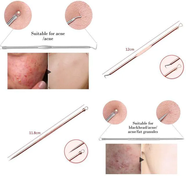 Alt view image 3 of 6 - ZTRHYOO Blackhead Remover Pimple Comedone Extractor Tool Acne Removal Kit with Case for Nose Face Skin, Rose