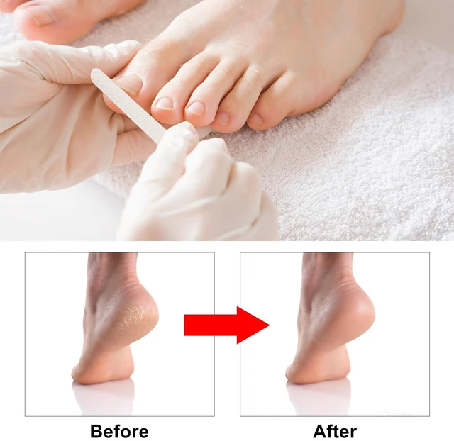 Alt view image 4 of 4 - 7 Pcs Professional Pedicure Tools for Feet, Stainless Steel Ingrown Toenail Removal Blade Kit with File, Toe Nail Knife Set for Men Women,Corn and Rasp Callus Remover Foot Scraper for Dead Skin