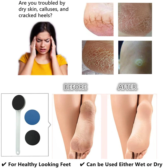 Alt view image 4 of 7 - Foot File Callus Remover 14" Long Handle, Foot Scrubber with Coarse and Fine Sand Paper 2-in-1 Pedicure Tool for Cracked Heels, Dry & Dead Skin, Soft and Smooth Feet, Clear White