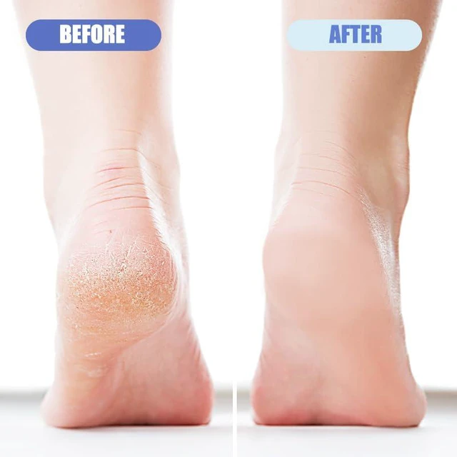 Alt view image 3 of 6 - 4 Pack Foot Pumice for Feet Pedicure Plastic Foot Scrubber Exfoliator for Dead Skin Cracked Heel Repair Callus Remover