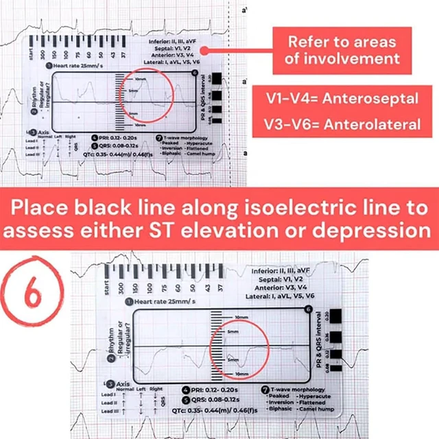 Alt view image 6 of 7 - 1Pc ECG 7 Step Ruler for ECG/EKG Interpretation, EKG Ruler Plastic Measuring Tool, Transparent Calipers Measuring Tool Follow a 7 Plan
