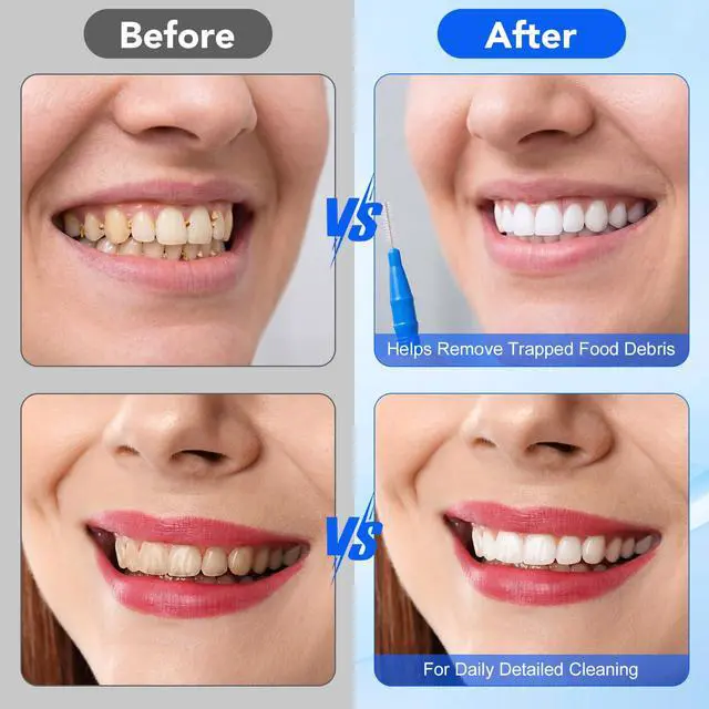 Alt view image 5 of 7 - 100 Pcs Interdental Brushes for Braces, Braces Brush for Cleaner | Toothpicks Soft Dental Floss Picks Teeth Cleaning Tools Braces Cleanerfor Teeth Oral Cleaning(Red,Blue)
