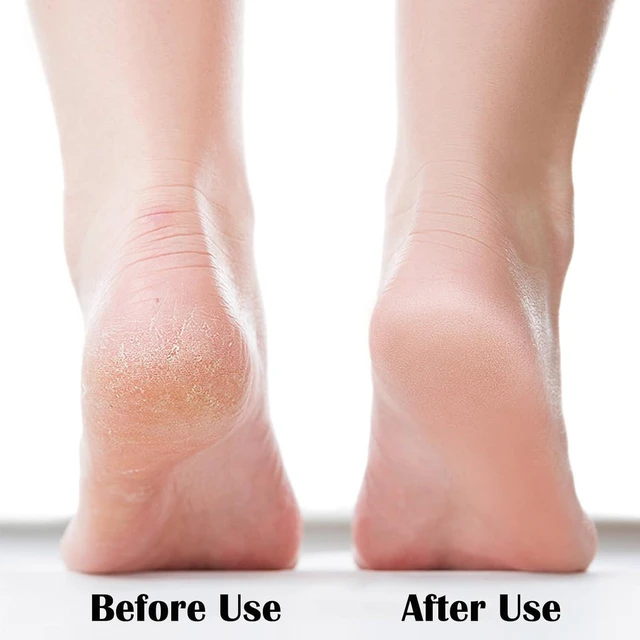 Alt view image 2 of 4 - Nano Foot File, Foot Scrubber Callus Remover, Foot Care Pedicure Tool, Foot File with Nano-Level Grinding Points, Portable Foot Scrubber for Dead Skin Removal, Cracking, Wet and Dry Feet