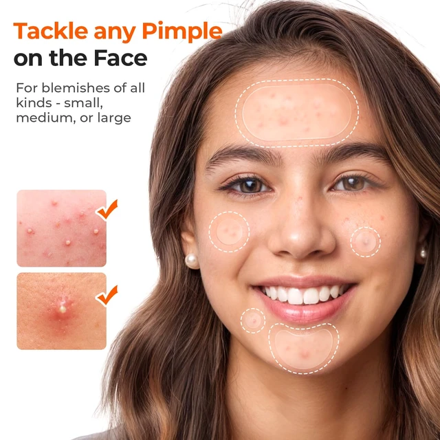 Alt view image 3 of 7 - 443 Count Pimple Patches for Face, Hydrocolloid Acne Cover Patch Bulk | Pimple Stickers for Cheeks, Forehead, Chin Blemishes Zit & Breakouts, All Skin Types, Dots, Strips, Contoured 5 Sizes Variety