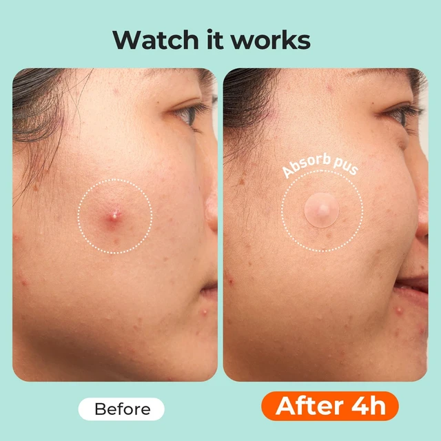Alt view image 6 of 7 - 443 Count Pimple Patches for Face, Hydrocolloid Acne Cover Patch Bulk | Pimple Stickers for Cheeks, Forehead, Chin Blemishes Zit & Breakouts, All Skin Types, Dots, Strips, Contoured 5 Sizes Variety