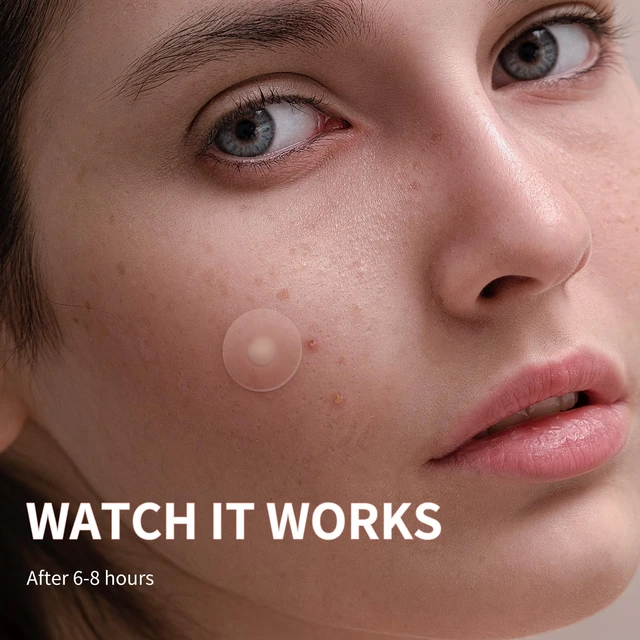 Alt view image 4 of 7 - Pimple Patches for Face, 4 Size 300 Counts Hydrocolloid Acne Patches | Pimple Patches for Covering Zits and Blemishes, Spot Stickers with Salicylic Acid, Tea Tree Oil & Calendula Oil