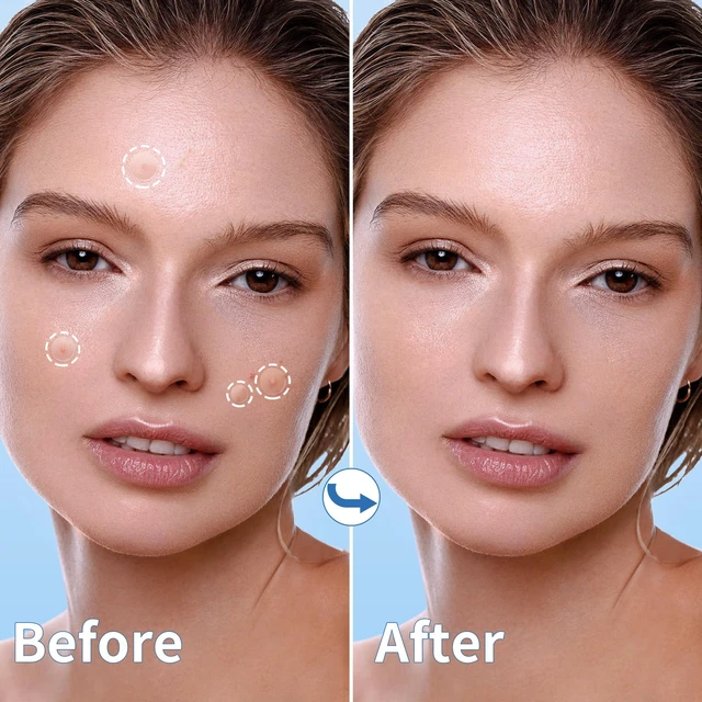 Alt view image 5 of 7 - Pimple Patches for Face, 4 Size 300 Counts Hydrocolloid Acne Patches | Pimple Patches for Covering Zits and Blemishes, Spot Stickers with Salicylic Acid, Tea Tree Oil & Calendula Oil