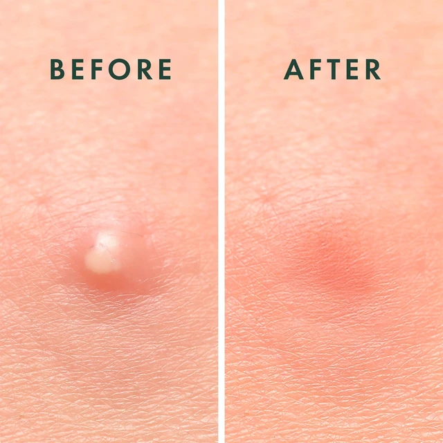Alt view image 5 of 7 - Miracle Invisible Spot Cover Hydrocolloid Acne Pimple Patches (96 Ct) | Ultra-Thin Patch for Face, Absorbs Fluid From Blemishes, Facial Sticker, Korean Skin Care, Pore Care, 2 Sizes