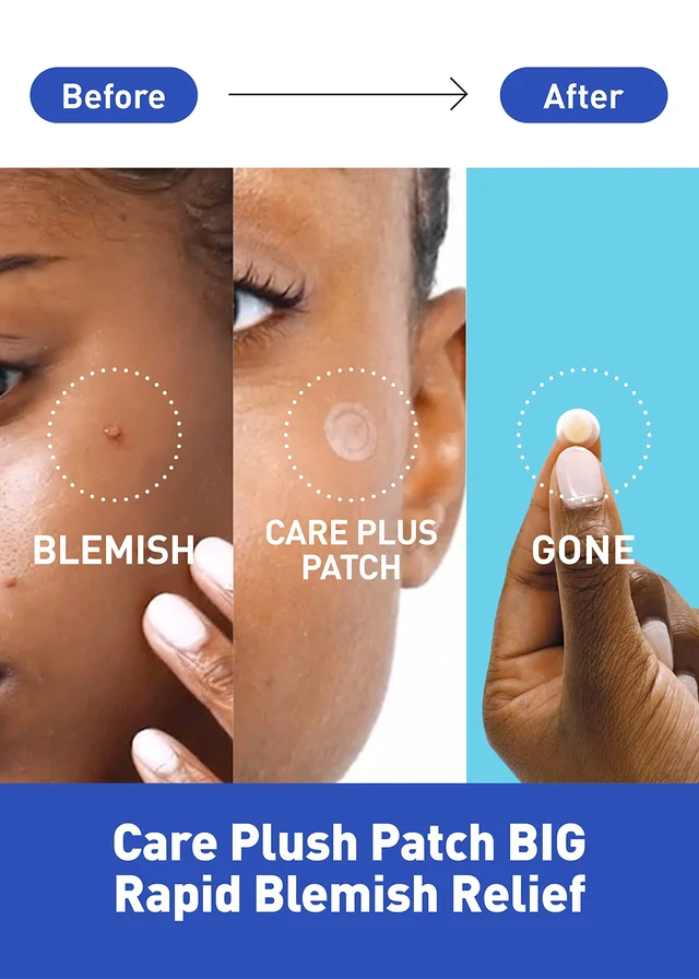 Alt view image 2 of 6 - Care Plus Spot Patch | Hydrocolloid Acne Korean Spot Patch to Cover Zits, Pimples and Blemishes, for Troubled Skin and Face (Hydrocolloid, 306 Count (Pack of 3))