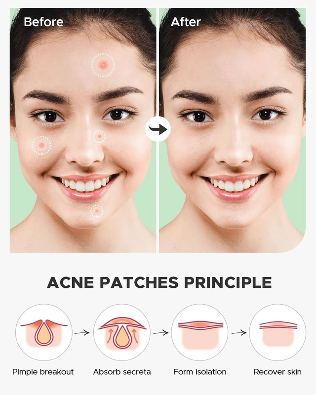 Alt view image 6 of 7 - Acne Pimple Patch for Face 180 Counts 4 Sizes | Invisible hydrocolloid zit patch with tea tree oil & calendula oil, acne spot patch, absorbs fluid from blemishes