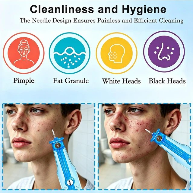 Alt view image 3 of 6 - 60PCS Pimple Popper Kit with 72 Acne Patches, Disposable Blemish Tool for Whitehead, Blackhead, Pimple Clearing, Ultra-Fine 0.3mm Tip for Home/Travel Use (Blue)