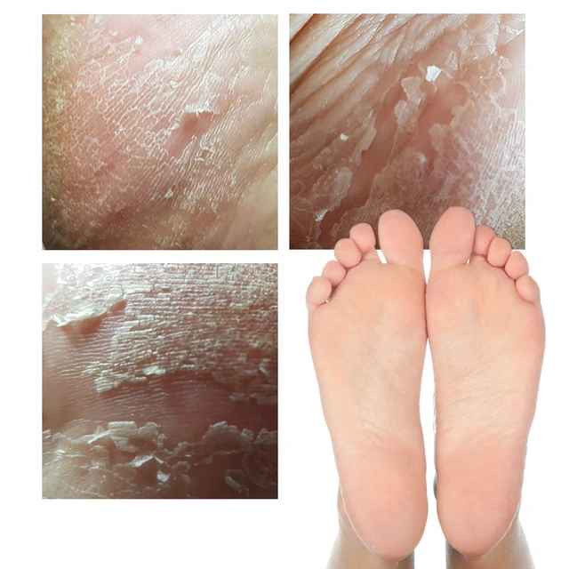 Alt view image 5 of 7 - Elizavecca/Foot Peel /1 Foot Pack 2 Pairs Foot Mask - Boots for Exfoliating/foot pack review/foot pack before and after