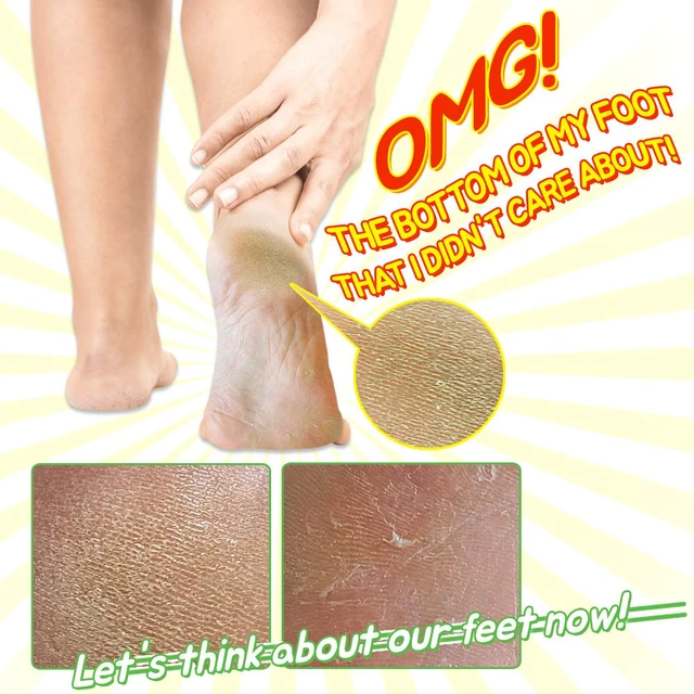 Alt view image 4 of 7 - Elizavecca/Foot Peel /1 Foot Pack 2 Pairs Foot Mask - Boots for Exfoliating/foot pack review/foot pack before and after