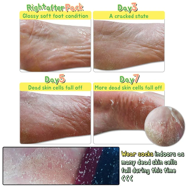 Alt view image 3 of 7 - Elizavecca/Foot Peel /1 Foot Pack 2 Pairs Foot Mask - Boots for Exfoliating/foot pack review/foot pack before and after