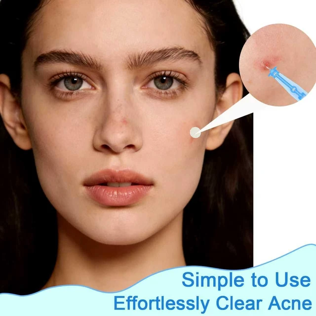 Alt view image 5 of 7 - 50pcs Disposable Blackhead and Blemish Remover Tools, 72 Dots Pimple Stickers - Sterile Needles for Acne, Whitehead, Comedone