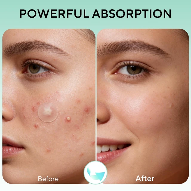 Alt view image 4 of 7 - QUSTERE 580 Count Pimple Patches for Face, Large Hydrocolloid Acne Patches Stickers Bandages, Blemishes Zit Breakouts for Cheeks, Forehead, Chin, Nose for Full Face & Body | 7 Sizes | 4 Shapes