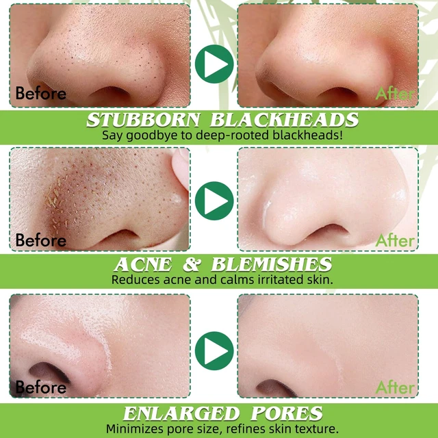 Alt view image 3 of 7 - Blackhead Remover Strips, Deep Cleansing Pore Strips, Instantly Unclogs Pores & Controls Oil, Charcoal Nose Strips for Men & Women, Suitable for All Skin Types (10 Counts)