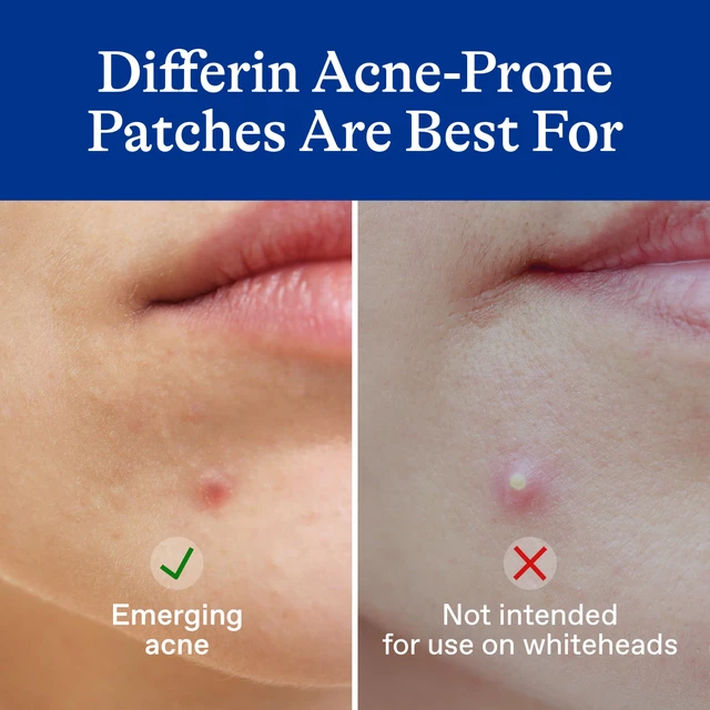 Alt view image 3 of 7 - Differin Acne Treatment Pimple Patches, Salicylic Acid & Centella, 36ct