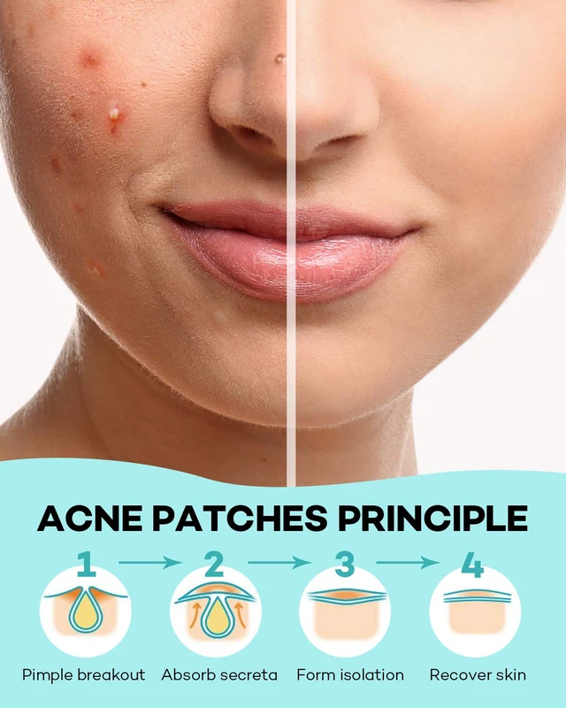 Alt view image 6 of 7 - TKTK Pimple Patch for Face, Hydrocolloid Acne Absorbing Dots, 4 Sizes 140CT