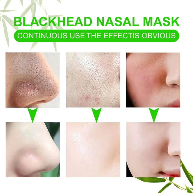 Alt view image 7 of 7 - Pore Strips,Natural Charcoal Deep Cleansing Pore Strips ,Nose Strips for Blackheads,Black Heads Removal for Nose Face,Deep Cleansing for All Skin Types(80pcs)