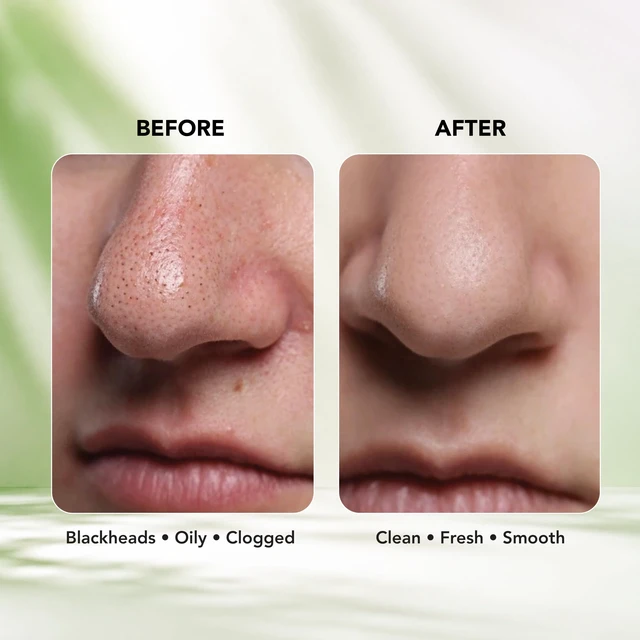 Alt view image 4 of 7 - DR.RASHEL Charcoal Nose Pore Strips For Pore Cleansing, Instant And Painless Blackheads Removal | Deep Purifying Blackhead Remover Strips for Nose | 20 PCS (10 Strips & 10 Wipes)