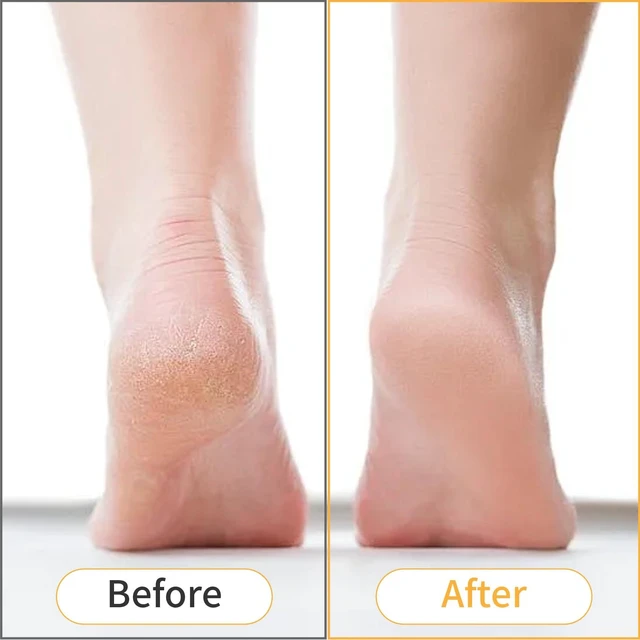 Alt view image 6 of 7 - 2 Pack Pumice Stone for Feet, Wooden Handle Foot Scrubber Callus Remover for Dead Skin, Heel Scraper for Dry Rough Feet Pedicure Tool