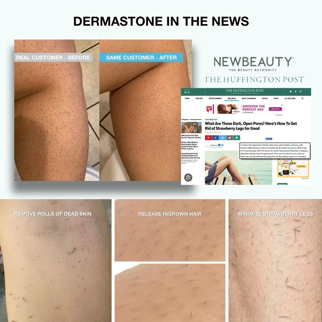 Alt view image 7 of 7 - LEG & BODY SCRUB - Deep Exfoliating Stone Body Scrubber for Strawberry Legs Treatment, Leg Exfoliator Ingrown Hair, Dead Skin Remover, Foot Scrub & Natural Body Exfoliator for Women Men