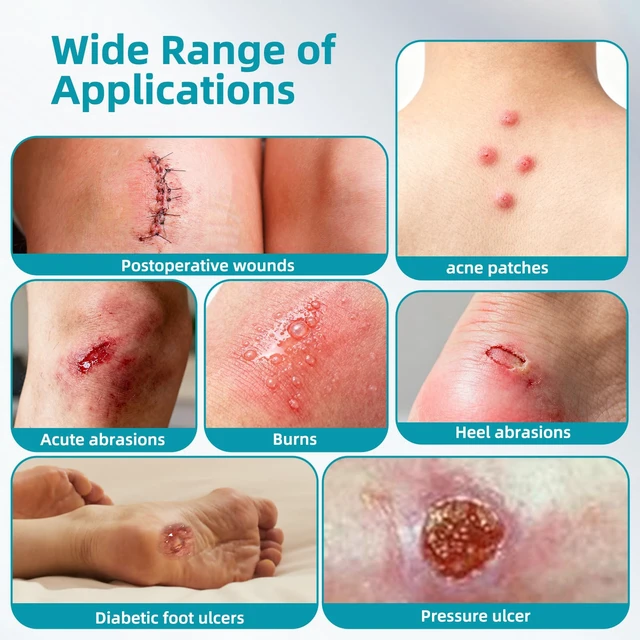 Alt view image 7 of 7 - Medical Grade Hydrocolloid Bandage Roll (2in*16ft), Highly Absorbent Hydrocolloid Dressings for Wound Care, Burn, Blister, Pimple Patches for Acne Care, Waterproof & Cut to Size