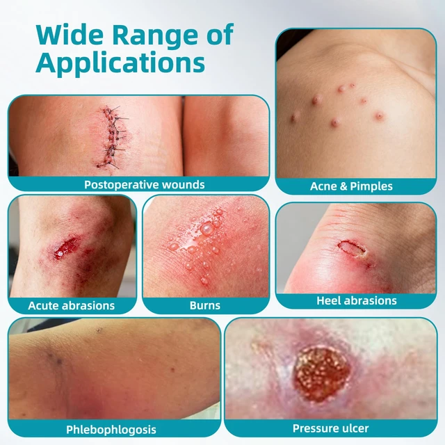 Alt view image 5 of 7 - Hydrocolloid Bandage Roll (3in*12ft), Highly Absorbent Hydrocolloid Dressings for Wound Care, Burn, Blister, Pimple Patches for Acne Care, Waterproof & Cut to Size