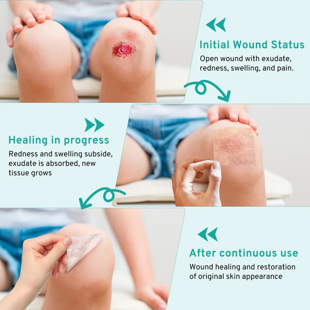 Alt view image 6 of 7 - Hydrocolloid Roll for Wound Care Gentle Self-Adhesive 12FT Skin-Friendly Waterproof Hydrocolloid Bandages with Flexible Fit for Minor Wounds, Blisters, Pimples, and Friction