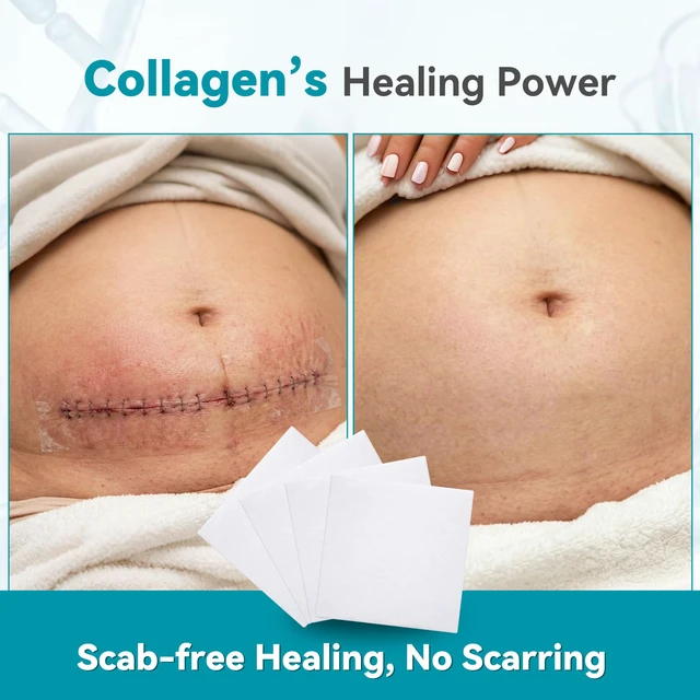 Alt view image 5 of 7 - Collagen Wound Dressing 2"X2" 5PCS 100% Bovine Type I Collagen Sponge, High Absorbency (4x Fluid), Biodegradable, For Chronic & Acute Wounds