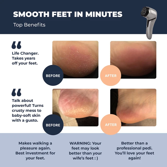 Alt view image 3 of 7 - Electric Foot Callus Remover with Vacuum - Professional Pedicure Tools Kit for Powerful Pedi Feet Care Vac, Electronic Foot File CR2100, Best for Hard, Dry, Cracked, Dead Skin (3 Rollers)